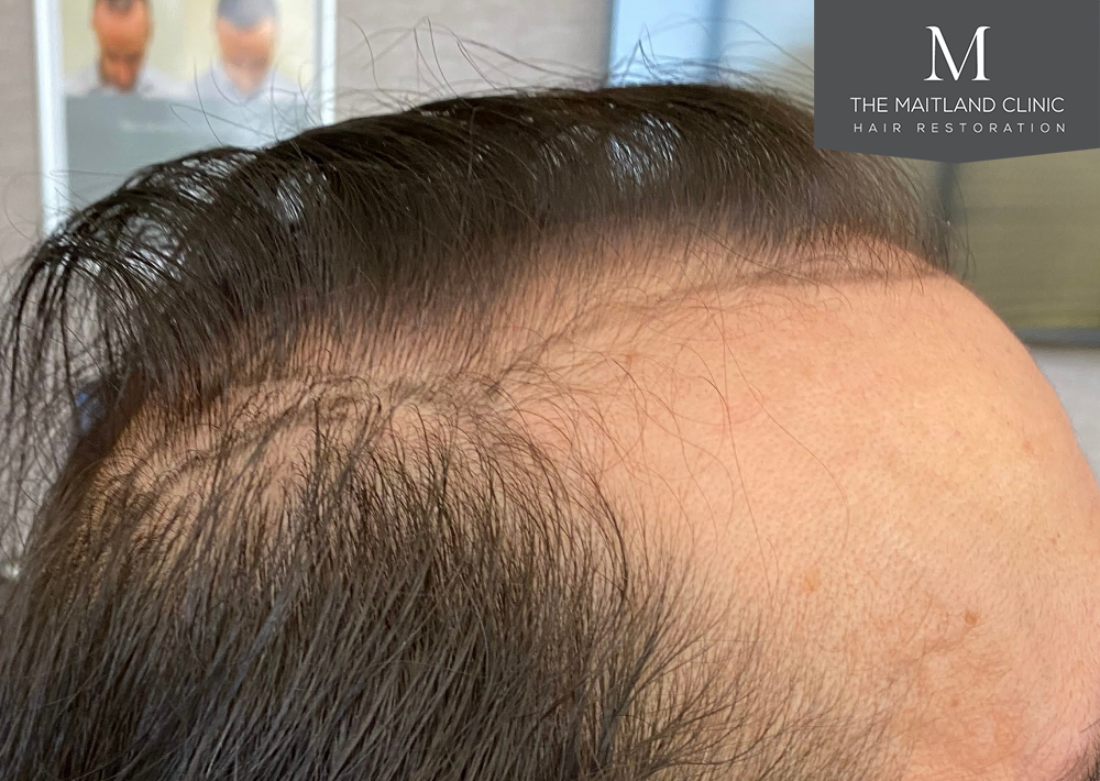 3803 grafts by FUT