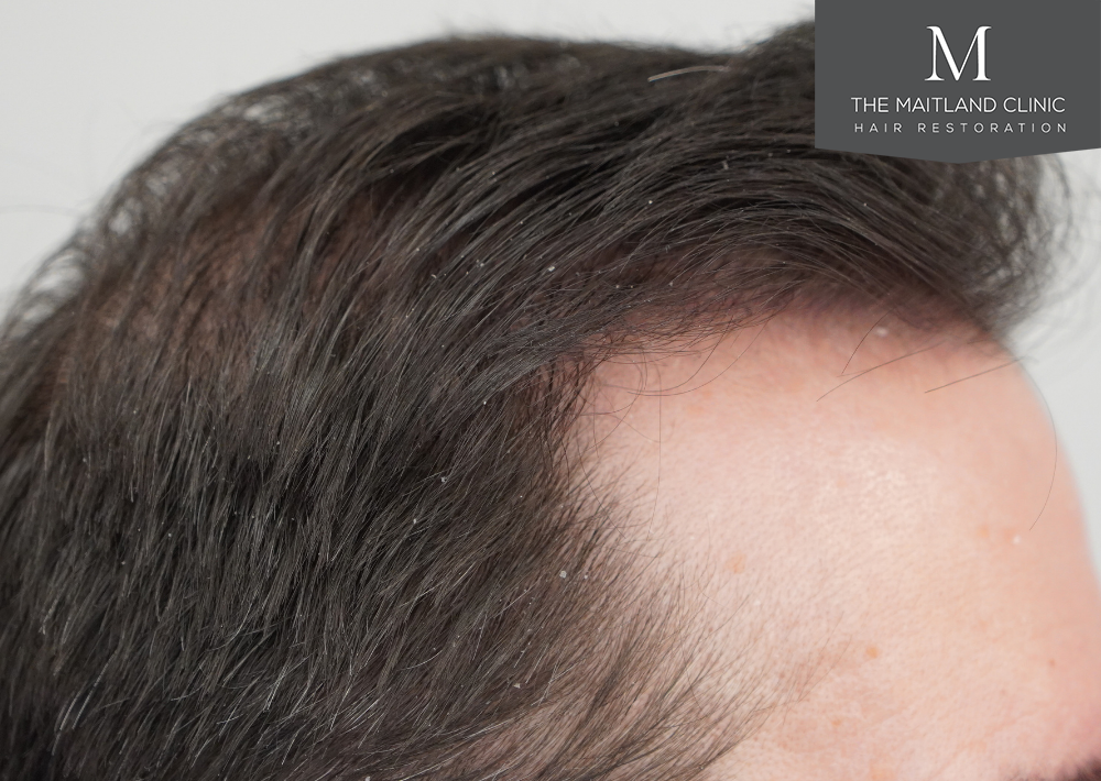 3803 grafts by FUT