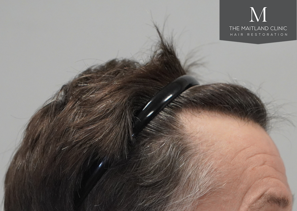 1357 grafts by FUE