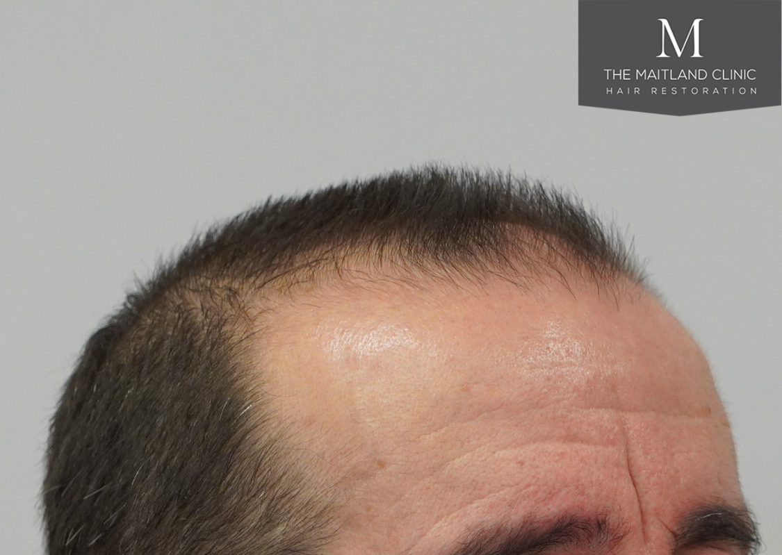 3803 grafts by FUT