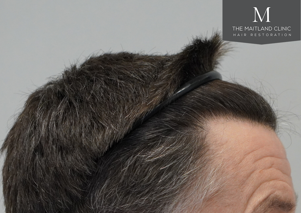 1357 grafts by FUE