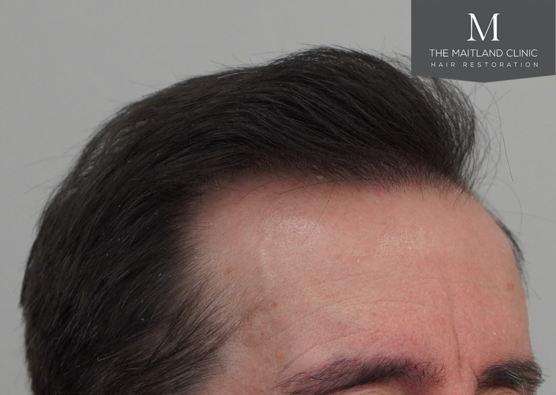 3803 grafts by FUT