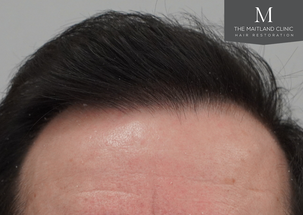 3803 grafts by FUT