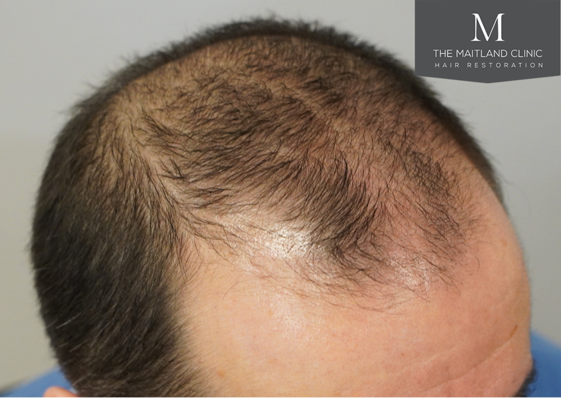 3803 grafts by FUT