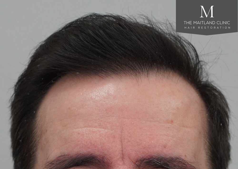 3803 grafts by FUT