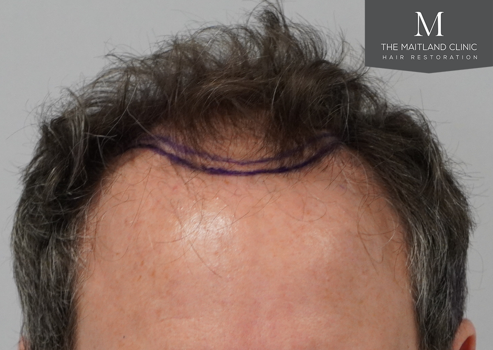 2560 grafts by FUE