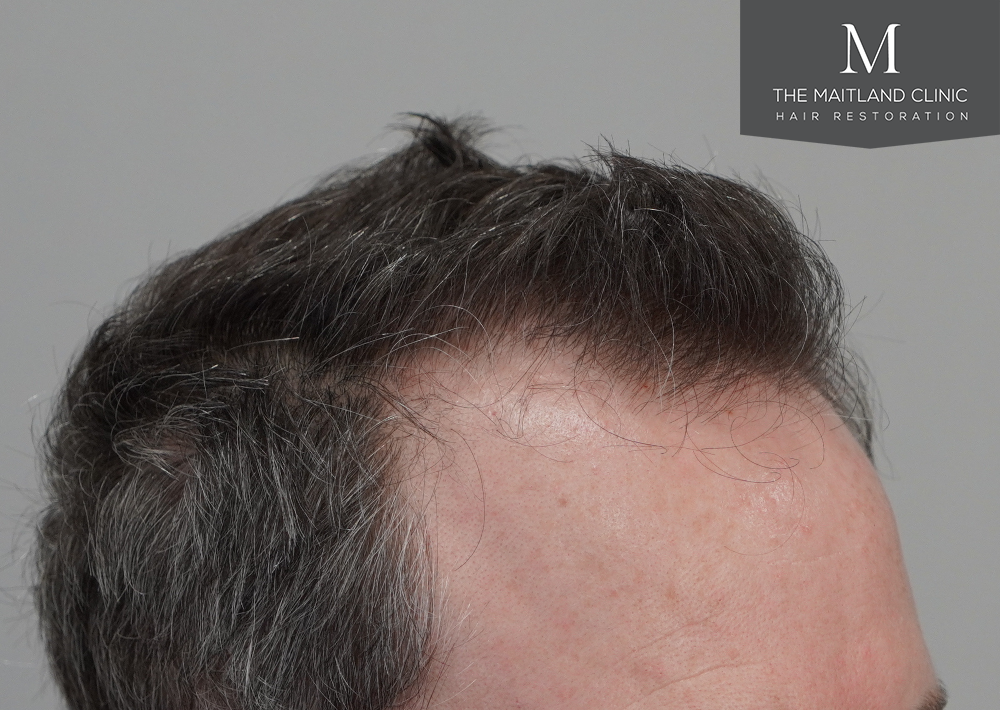 2560 grafts by FUE