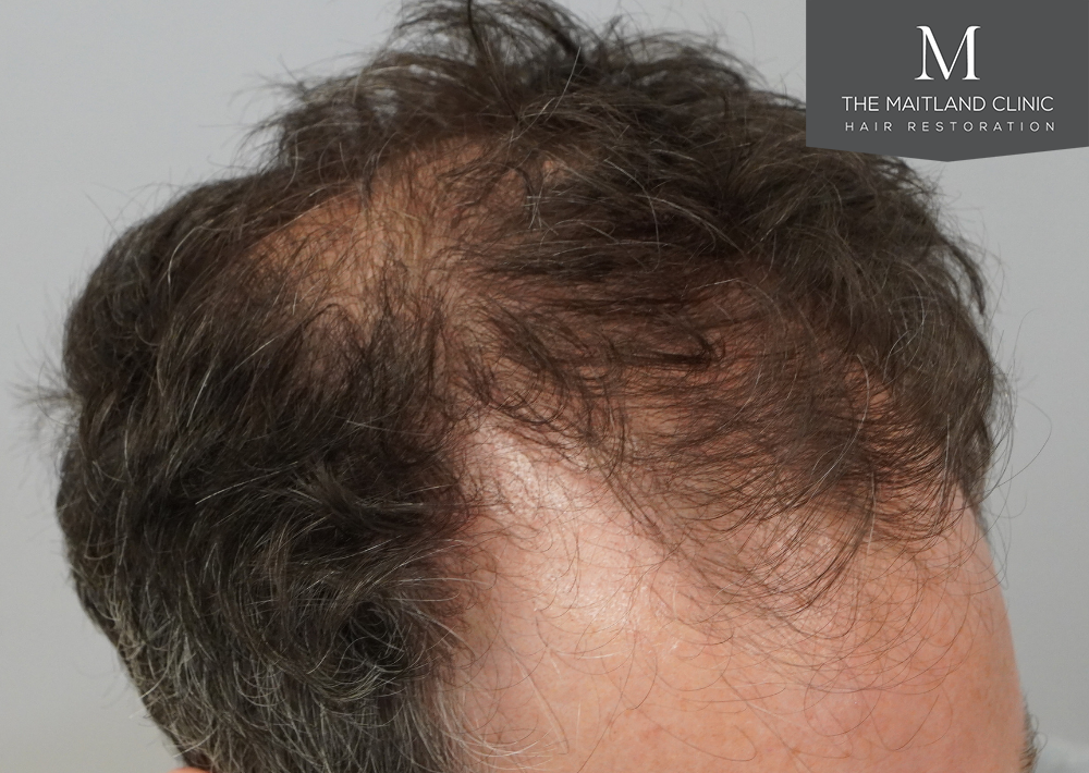 2560 grafts by FUE