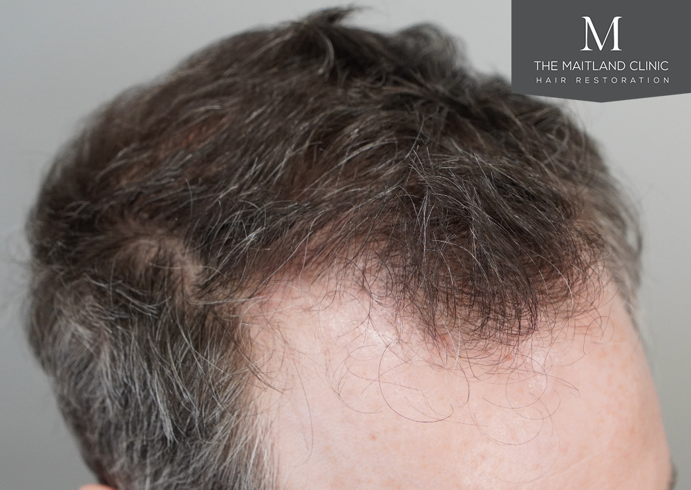 2560 grafts by FUE