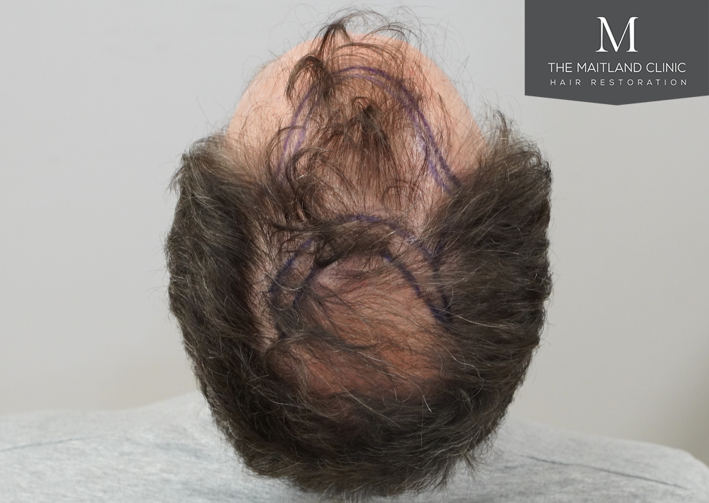 2560 grafts by FUE