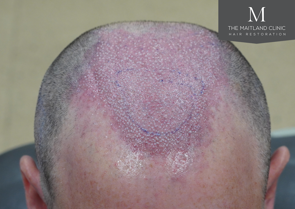 2560 grafts by FUE