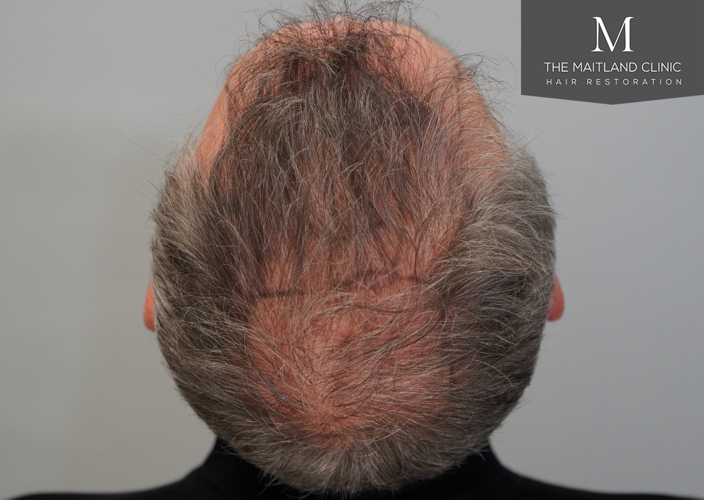 2448 grafts by FUT