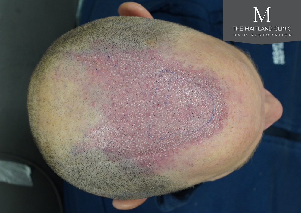 2560 grafts by FUE