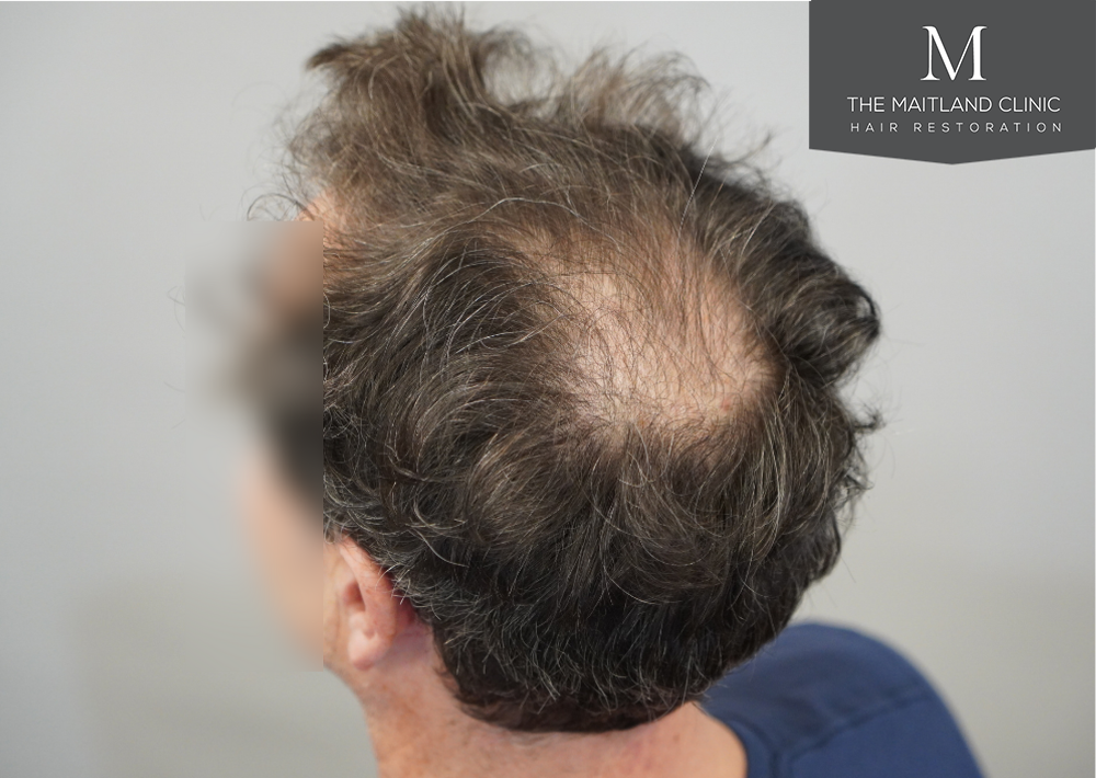 2560 grafts by FUE