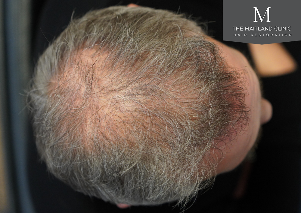 2448 grafts by FUT