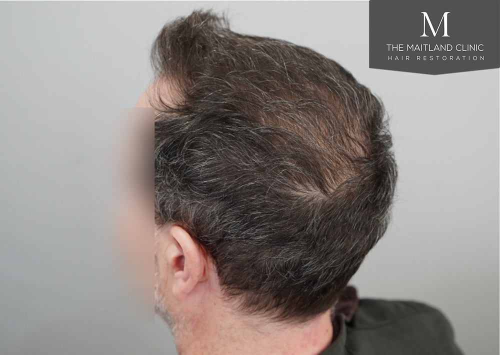 2560 grafts by FUE