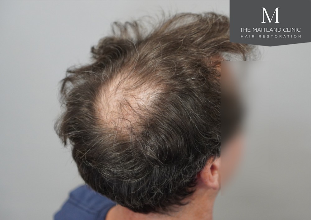 2560 grafts by FUE