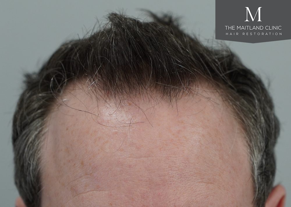 2560 grafts by FUE