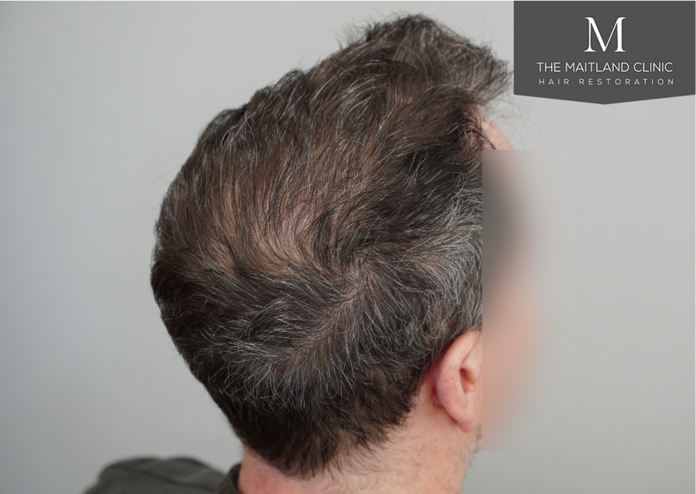 2560 grafts by FUE
