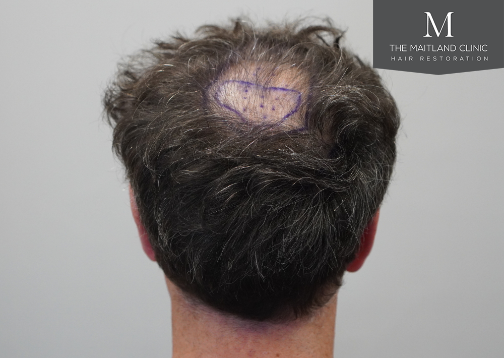 2560 grafts by FUE