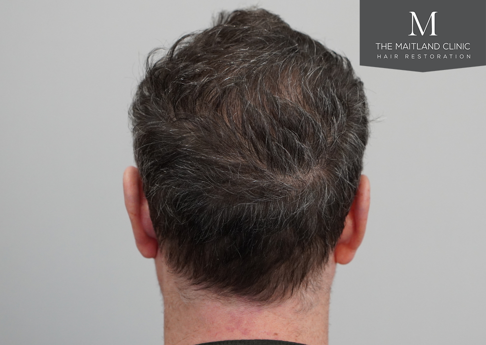 2560 grafts by FUE