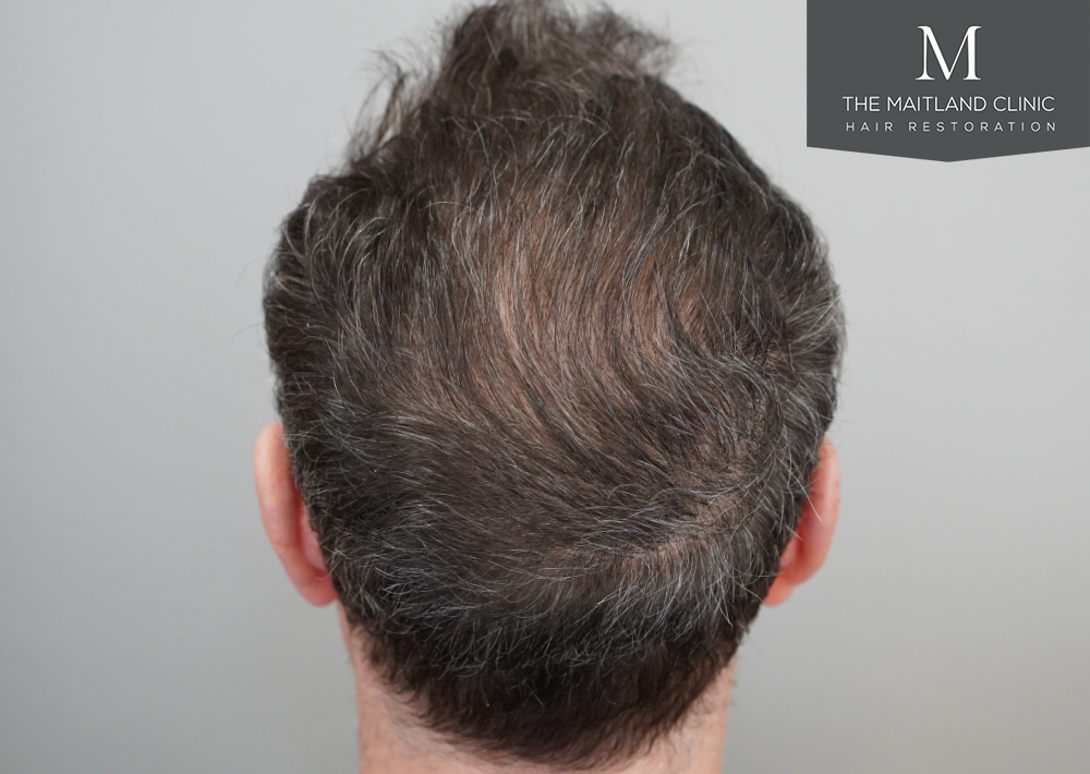 2560 grafts by FUE