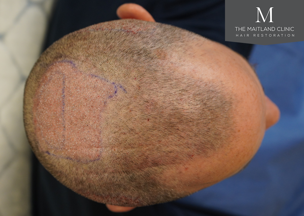 2560 grafts by FUE