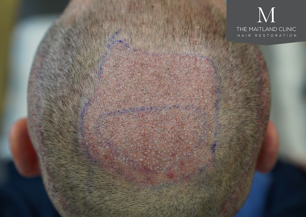 2560 grafts by FUE