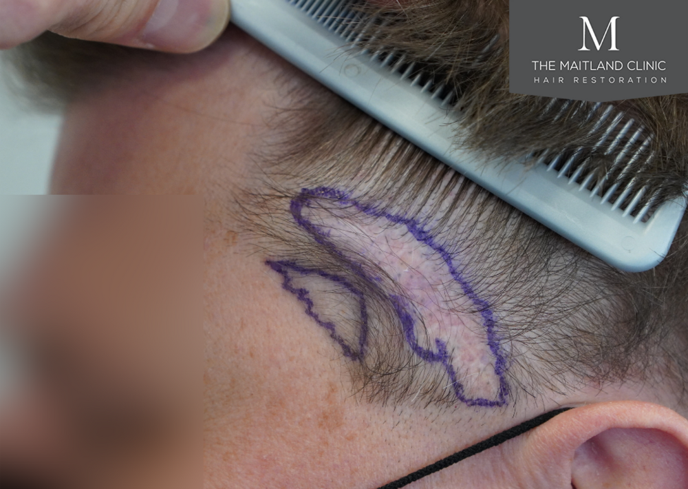 237 grafts by FUE