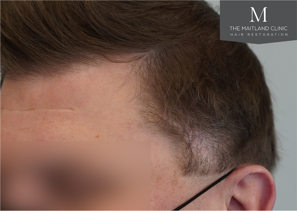 237 grafts by FUE