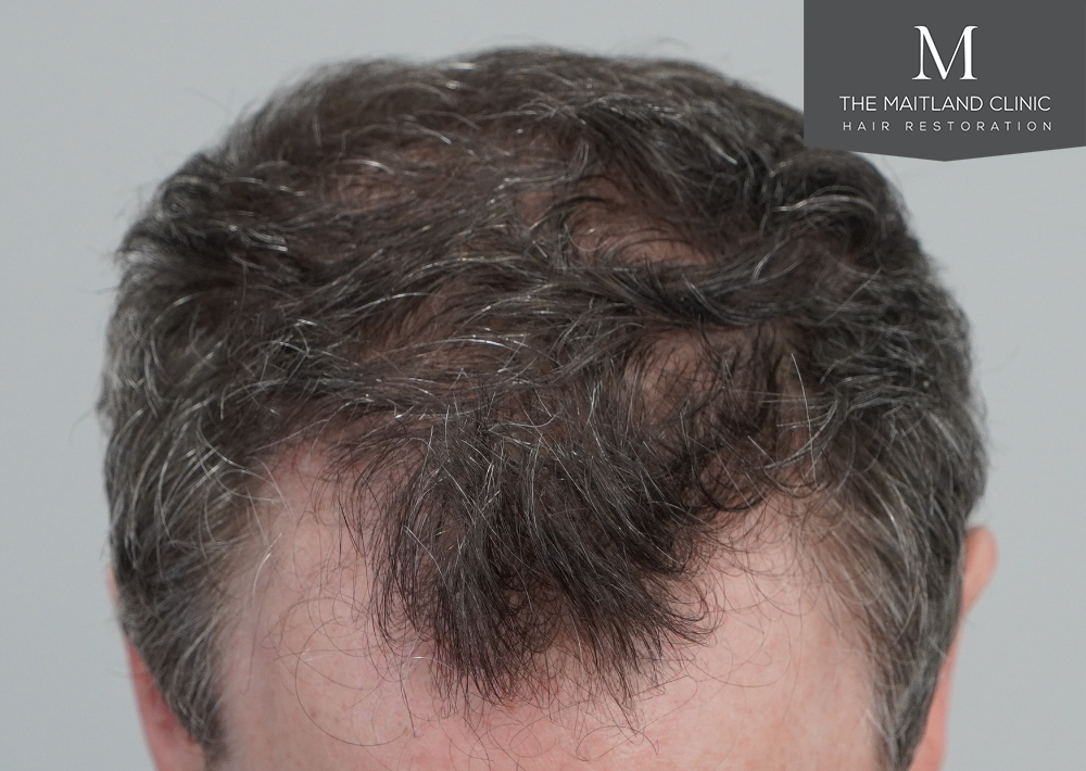 2560 grafts by FUE