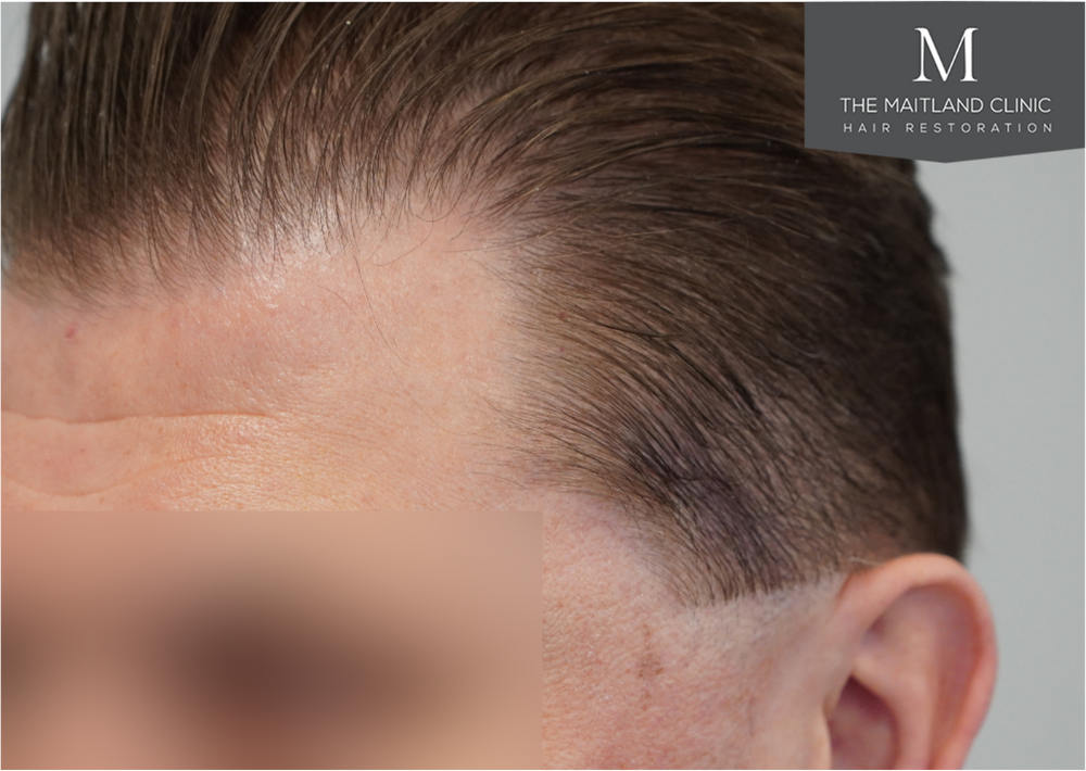 237 grafts by FUE