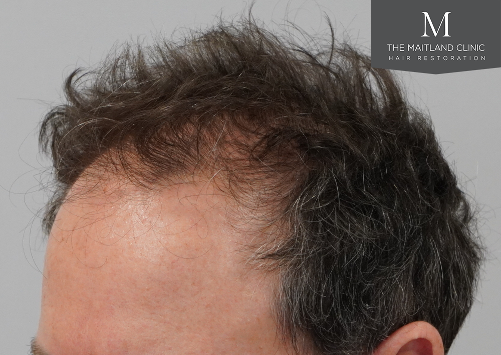 2560 grafts by FUE