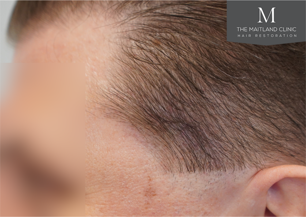 237 grafts by FUE