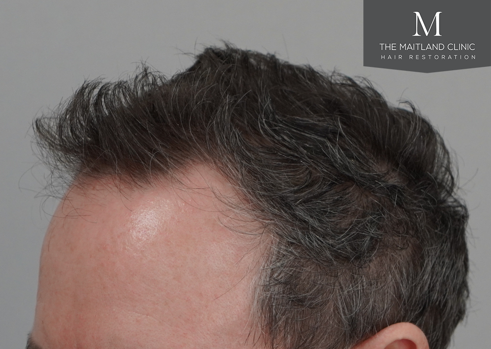 2560 grafts by FUE