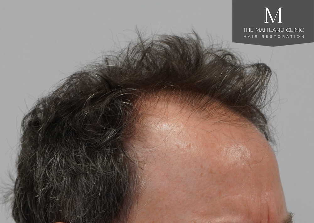 2560 grafts by FUE