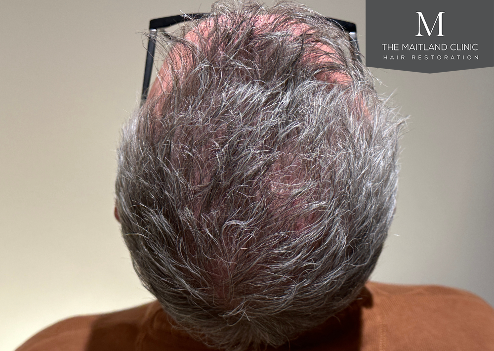 2448 grafts by FUT