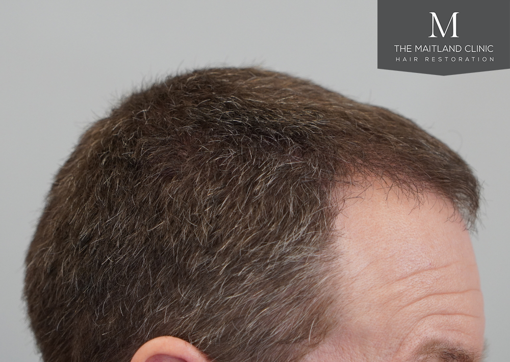 1603 grafts by FUE