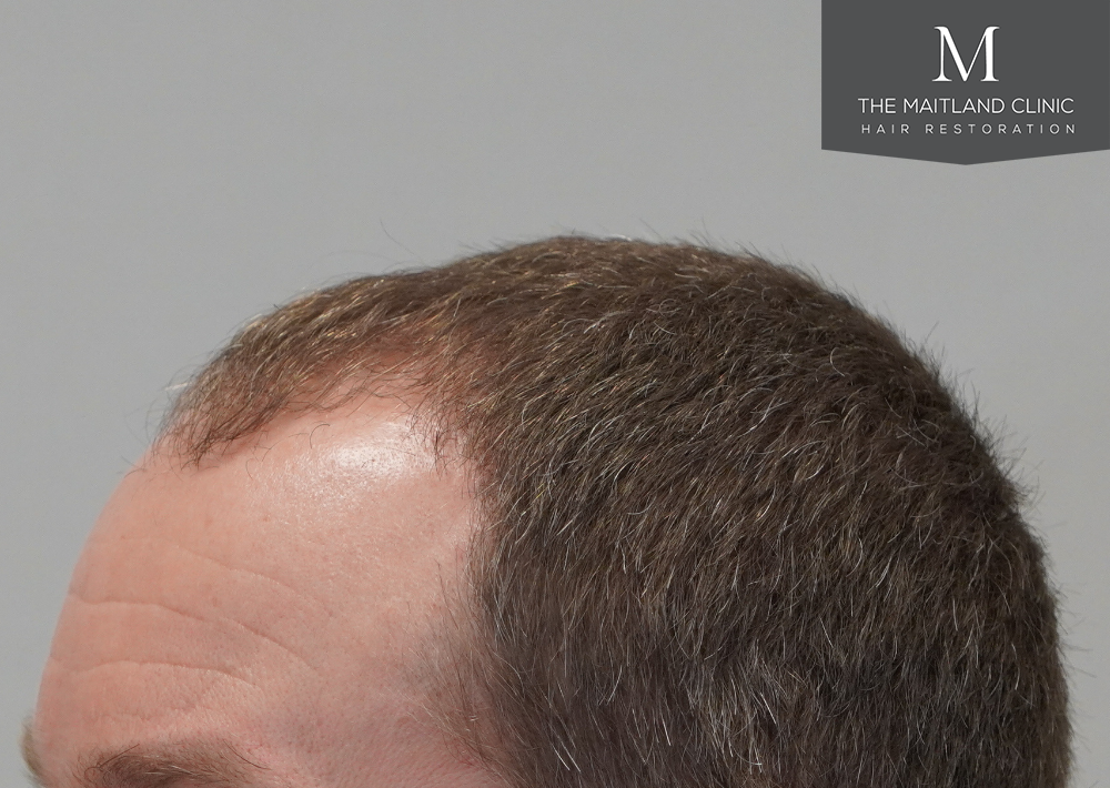 1603 grafts by FUE