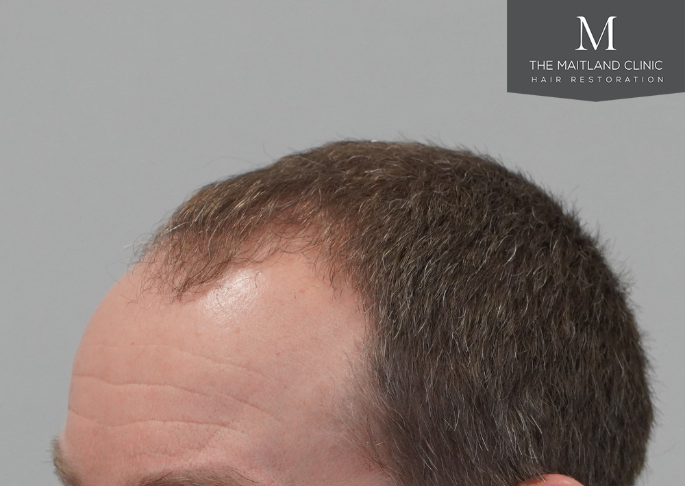 1603 grafts by FUE