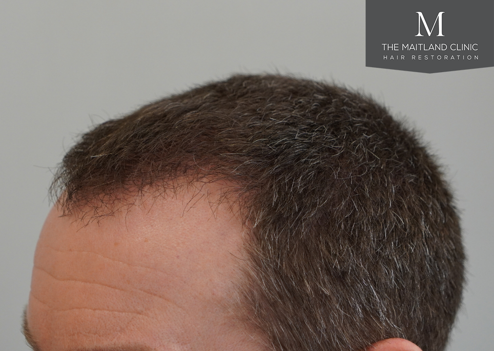 1603 grafts by FUE