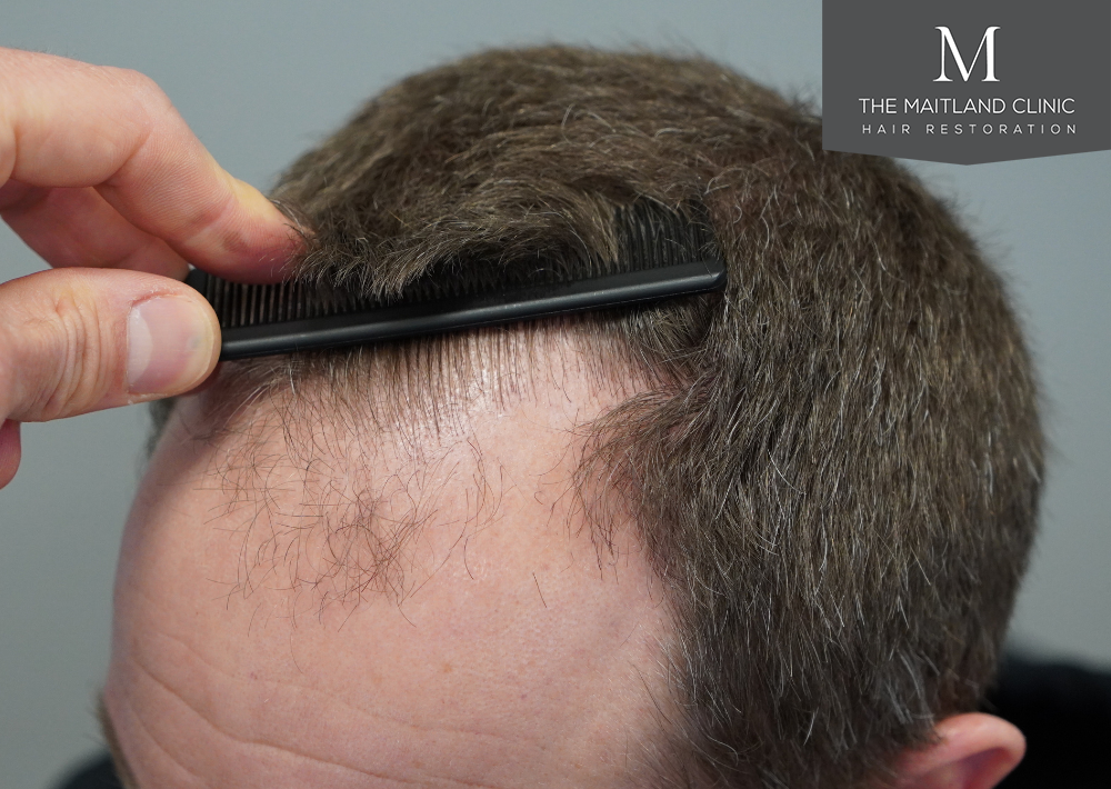 1603 grafts by FUE