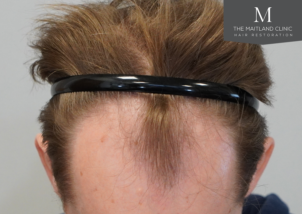 2023 grafts by FUE