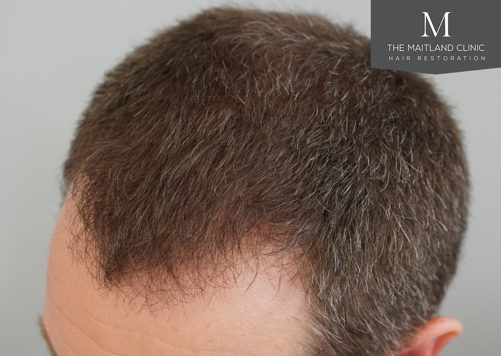 1603 grafts by FUE