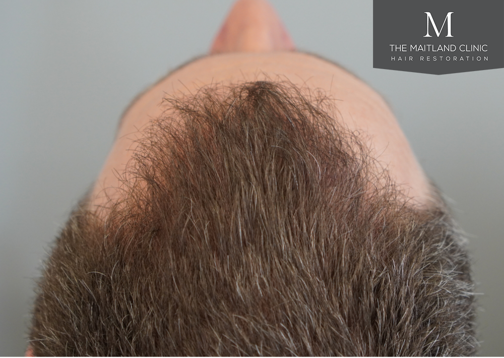 1603 grafts by FUE