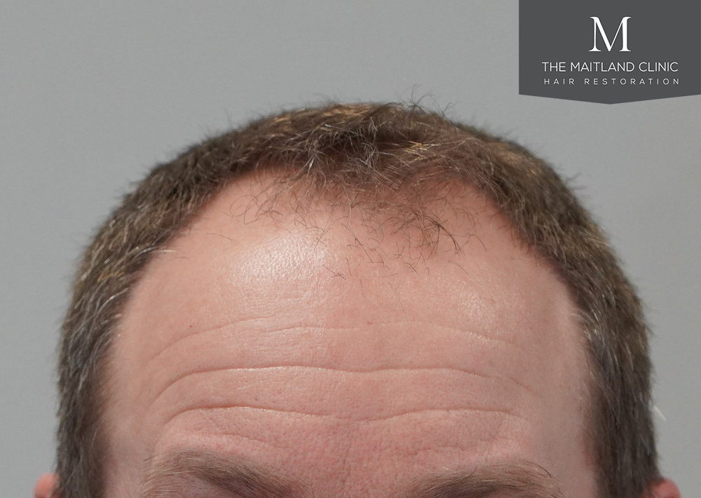 1603 grafts by FUE