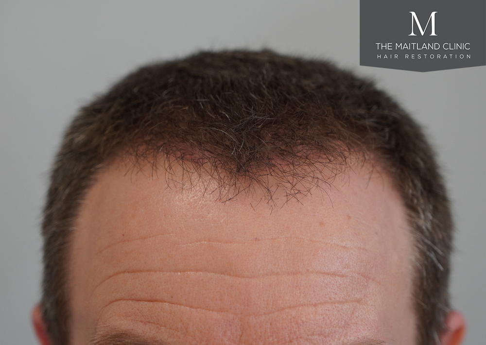 1603 grafts by FUE