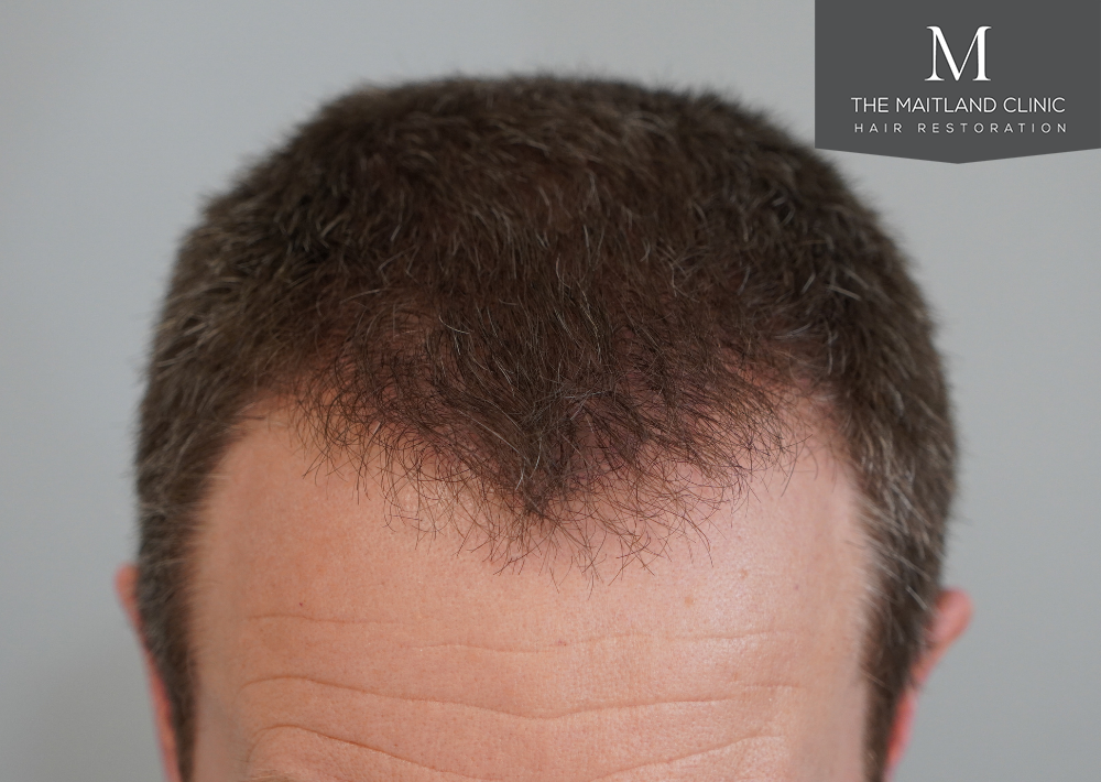 1603 grafts by FUE