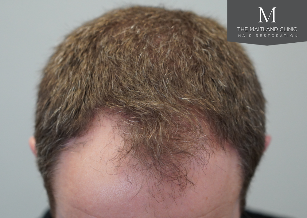 1603 grafts by FUE