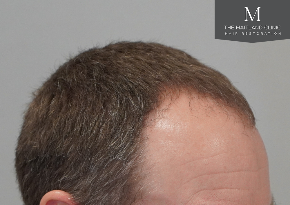 1603 grafts by FUE